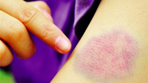 Nguyên nhân gây giảm tiểu cầu và cách phòng ngừa