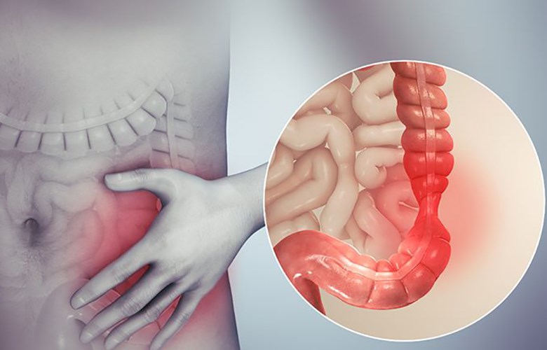 Các dấu hiệu cảnh báo của trường hợp khẩn cấp về viêm đại tràng