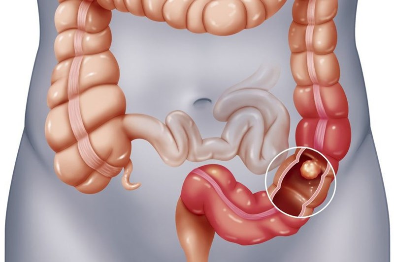 NHỮNG DẤU HIỆU NHẬN BIẾT BỆNH VIÊM ĐẠI TRÀNG TỪ SỚM