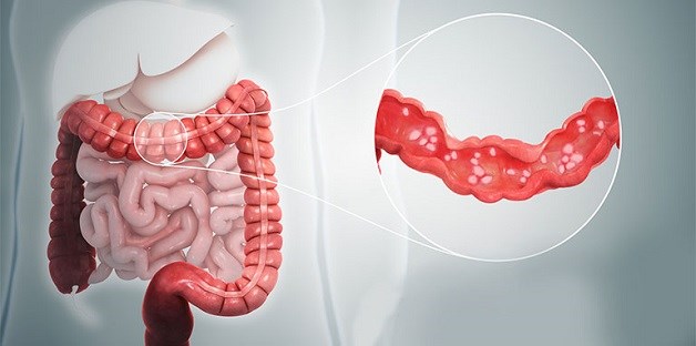 PHÒNG TRÁNH BỆNH VIÊM ĐẠI TRÀNG